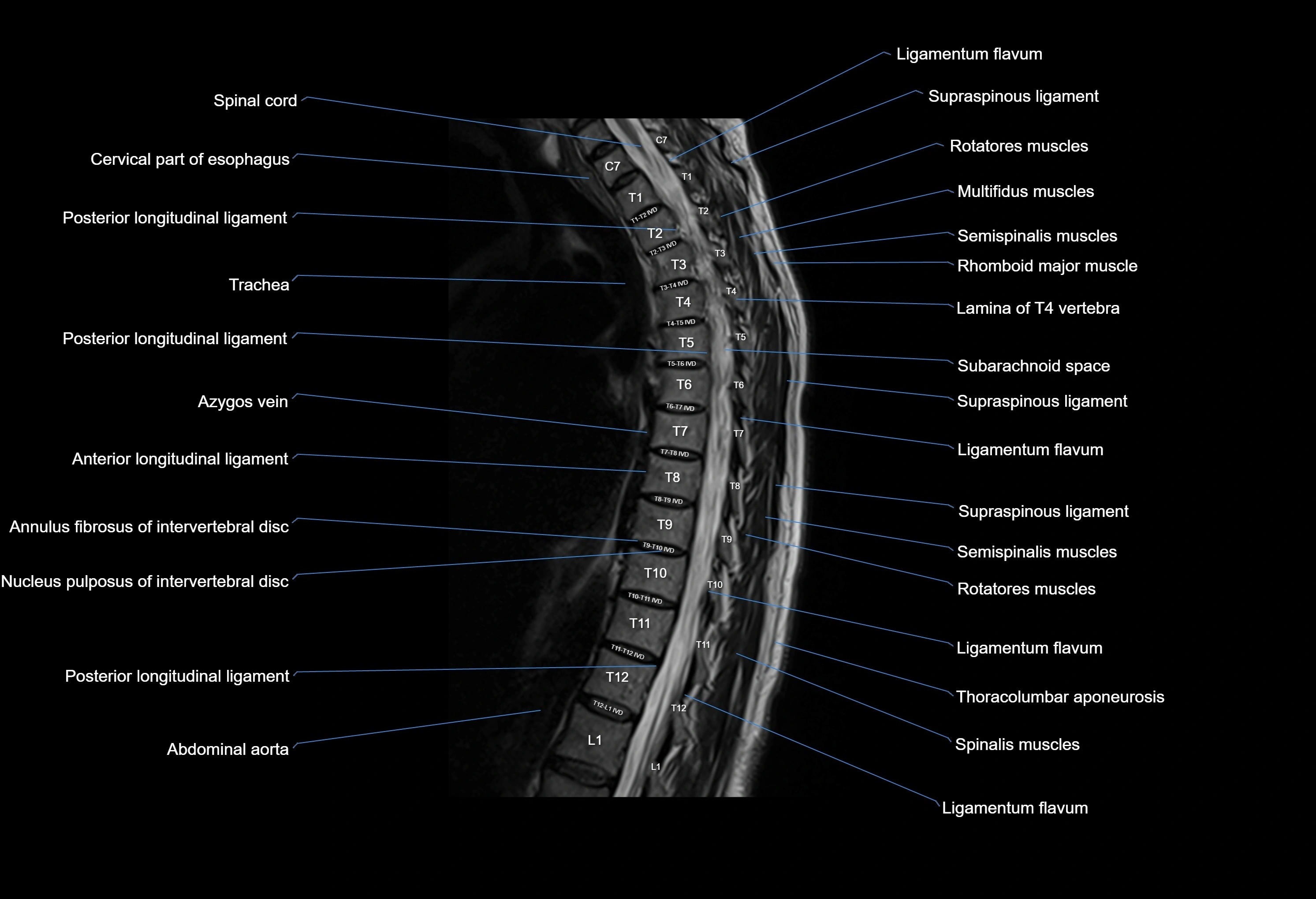 MRI thoracic spine sagittal  cross sectional anatomy 3T radiology  image-img-00001-00015.webp